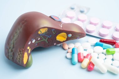 Hap tedavisi gören karaciğer modeli, siroz, karaciğer kanseri, yağlı karaciğer..