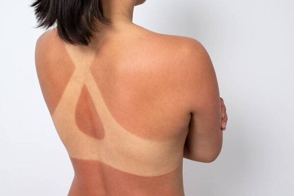 голая женщина сзади с солнечными ожогами и следами купальника. на белом фоне
.