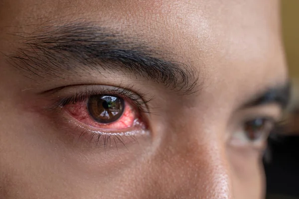 Irritated red eyes need sterile eye drops — Stock Photo, Image