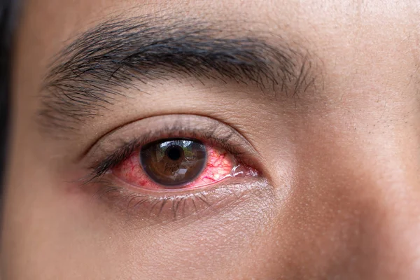 Close up of man red irritated eyes — Stock Photo, Image