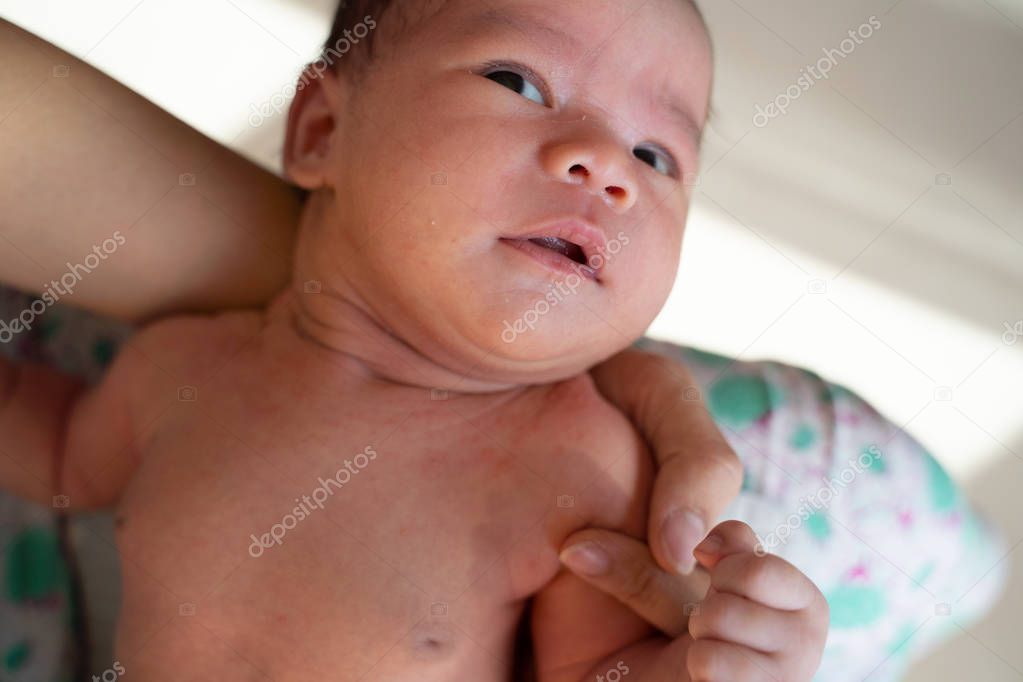 baby with allergic skin. newborn infant