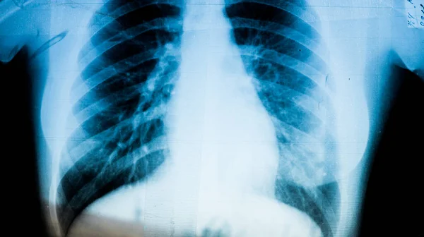 Рентген Пациента Пневмонией Вблизи Отражающей Рентгеновской Доске Больнице — стоковое фото