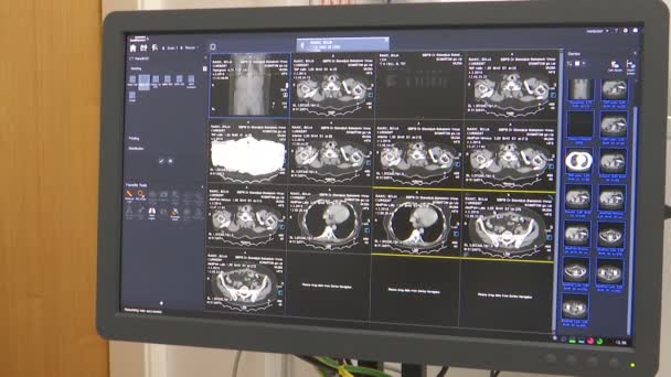 Resultaten Och Analysen Lungan Hos Skannern Monitorn — Stockvideo