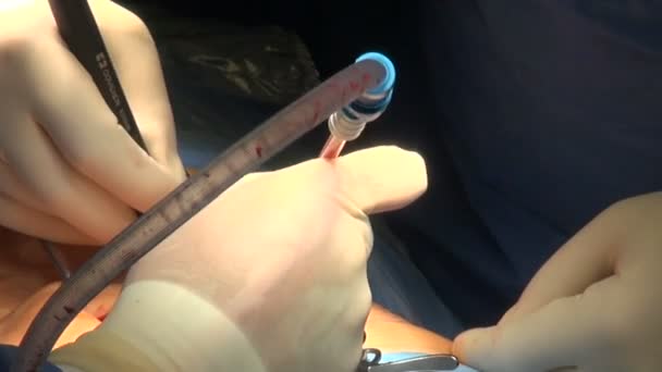 Las Manos Del Cirujano Operan Con Instrumentos Quirúrgicos Cuerpo Humano — Vídeo de stock