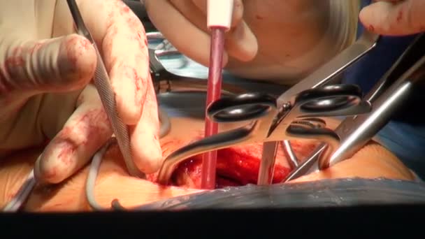 Two Surgeon Performed Rare Surgery Human Spine Different Surgical Tools — Stock Video