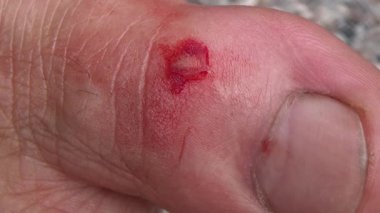 Ayak parmağında kanama.