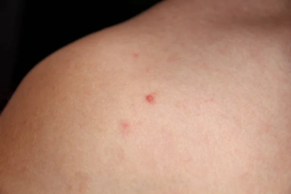 Espinilla inflamada en la piel humana, concepto médico —  Fotos de Stock