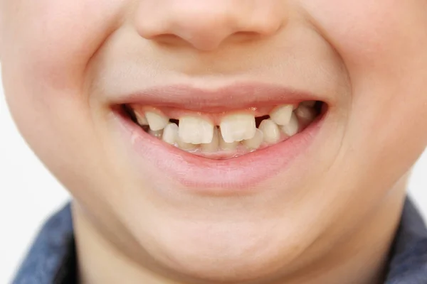 Chłopiec Dziecko Uśmiechnięte Otwartymi Ustami Zbliżenie Ust Dziecka Koncepcja Pielęgnacji — Zdjęcie stockowe