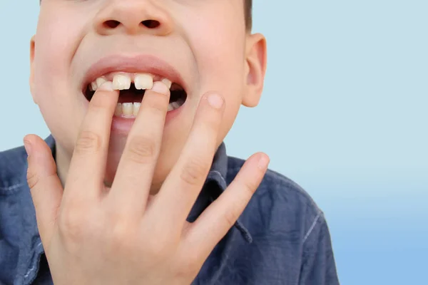 Criança Criança Mostra Com Dedo Dente Leite Que Balança Dói — Fotografia de Stock