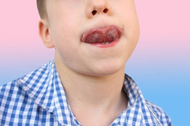 Çocuk, konuşma aygıtlarının geliştirilmesi için eklem egzersizleri, yakın çekim dili, konuşma bozuklukları konsepti, düzeltme yöntemleri, düzeltici gelişim egzersizleri yapıyor.