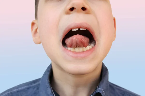 boy, kid performs articulation exercises for mouth, concept of speech disorders, correction, frenum of tongue, methods of correctional developmental exercises