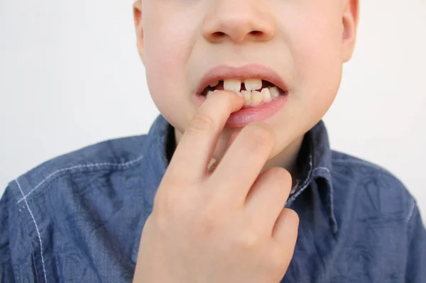 Dziecko Dziecko Pokazuje Palcem Ząb Mleczny Który Kołysze Się Boli — Zdjęcie stockowe
