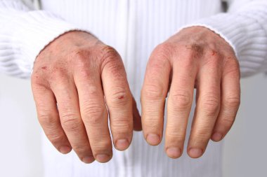 Kuru deri hasarı olan erkek ellerini kapat. Dermatoloji kavramı. İnsan eli ve derisi çatlaklara ve yaralara sahiptir. İnsan elleri yakın.