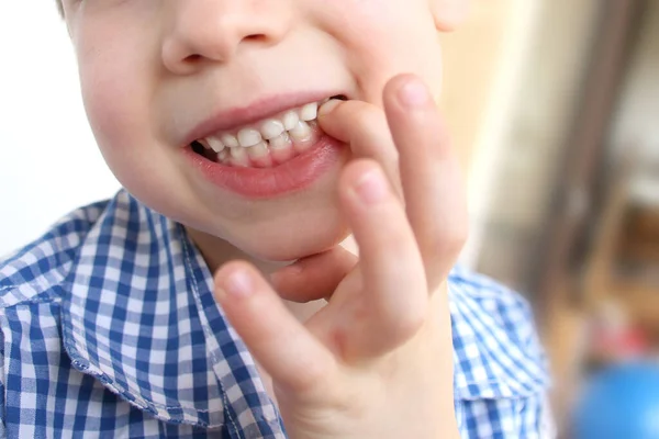 Criança Criança Mostra Com Dedo Dente Leite Que Balança Dói — Fotografia de Stock