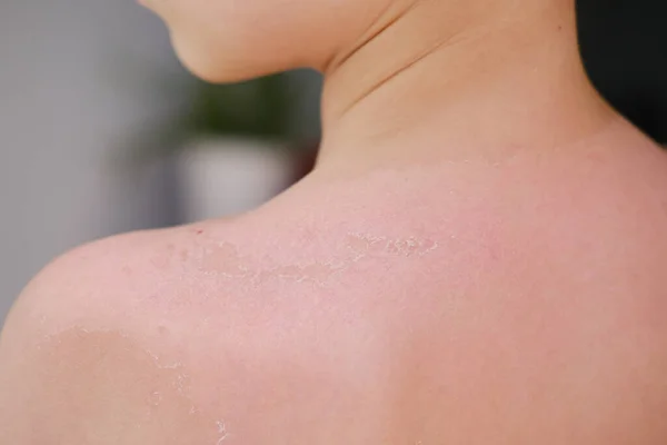 日焼け止め6 7歳の少年の日焼け止めと体の衛生コンセプト日焼け止めで死んだ肌を剥がす子供の背中 — ストック写真