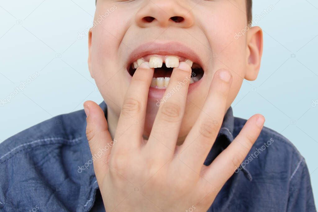 child, kid shows with his finger a milk tooth that sways and hurts, the concept of pediatric dentistry, dental treatment and correction of occlusion, oral care