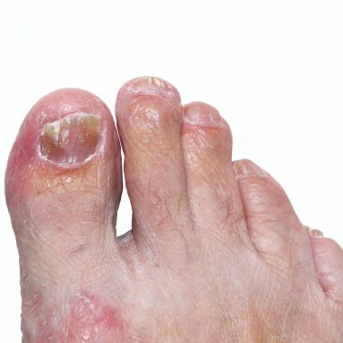 Ayak ve ayak parmaklarının derisini etkileyen orta ve şiddetli bir atlet ayağı (tinea pedis) vakası. Ayrıca ayak tırnağı mantarı (sağ ayak)).