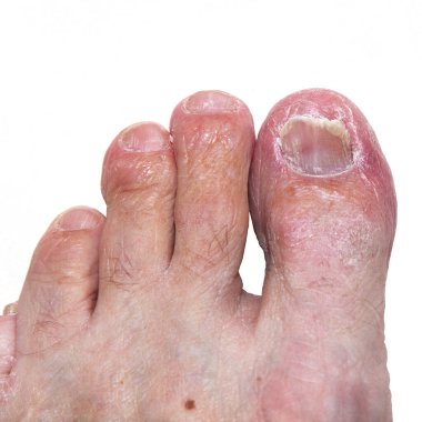 Ayak ve ayak parmaklarının derisini etkileyen orta ve şiddetli bir atlet ayağı (tinea pedis) vakası. Ayrıca ayak tırnağı mantarı da görünüyor..