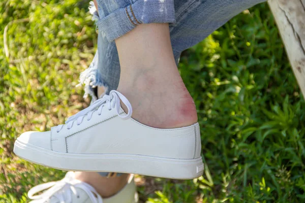 Chica Frotó Callo Después Ponerse Nuevos Zapatos Cuero — Foto de Stock