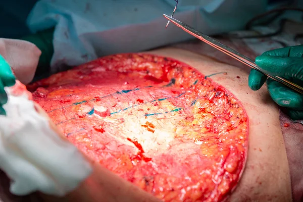 Abdominoplastia quirúrgica — Foto de Stock