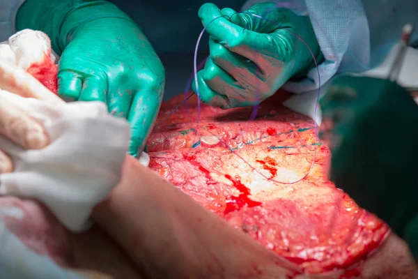 腹部形成外科手術 — ストック写真