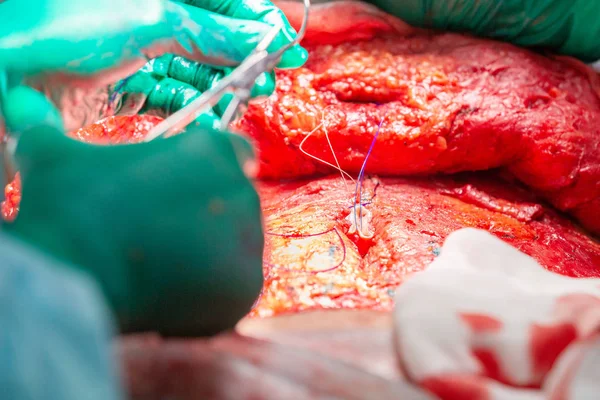 Abdominoplastia quirúrgica —  Fotos de Stock