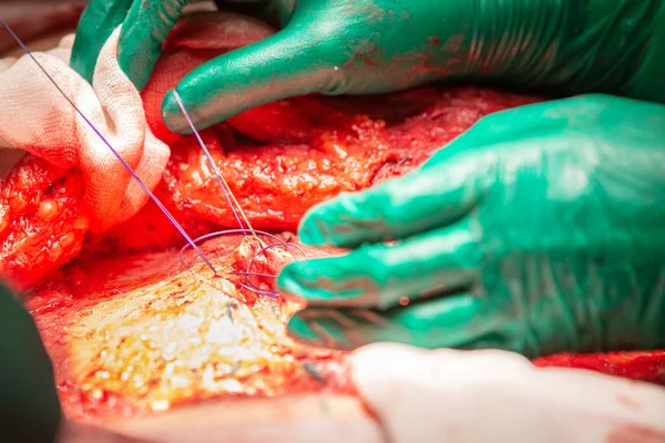 Chirurgický zákrok abdominoplastika — Stock fotografie