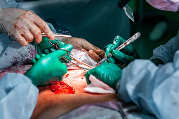 Chirurgický zákrok abdominoplastika — Stock fotografie