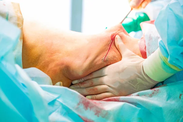 Cirurgia de lipoaspiração estética em sala de cirurgia real mostrando mãos do cirurgião e cânula — Fotografia de Stock