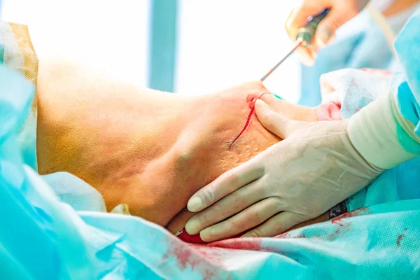 Cirurgia de lipoaspiração estética em sala de cirurgia real mostrando mãos do cirurgião e cânula — Fotografia de Stock