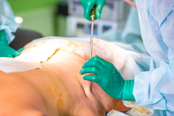 Kozmetikai Zsírleszívás műtét tényleges műtőben, sebészek kanül dolgozó csoport — Stock Fotó