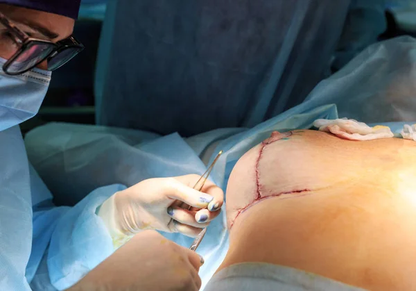 Operação de perto. Cirurgia de aumento mamário na sala de cirurgia — Fotografia de Stock