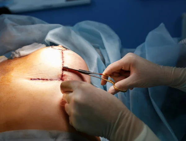 Operation close up. Breast augmentation surgery in the operating room
