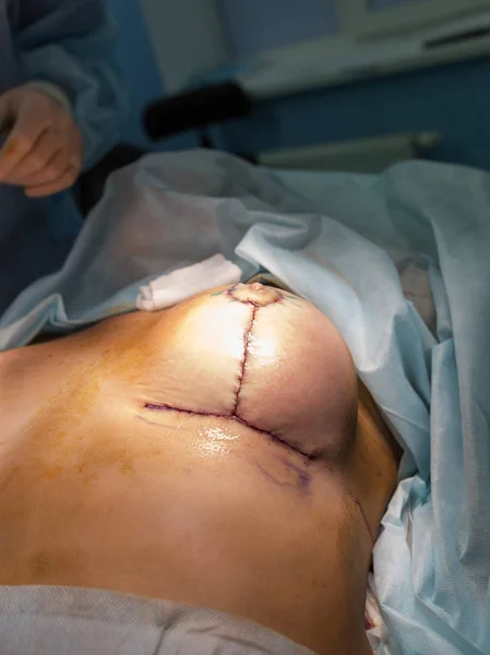 Operation close up. Breast augmentation surgery in the operating room