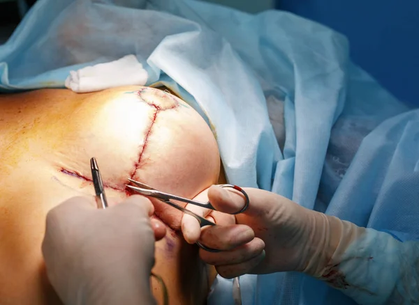 Operation aus nächster Nähe. Brustvergrößerung im Operationssaal Stockfoto