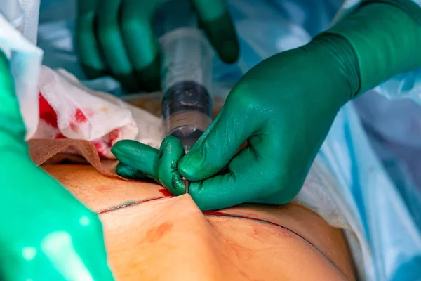 Cirugía de liposucción cosmética en quirófano real, grupo de cirujanos que trabajan con cánula — Foto de Stock