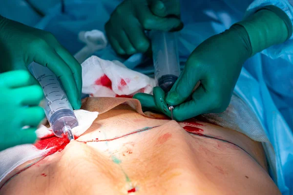 Cirugía de liposucción cosmética en quirófano real, grupo de cirujanos que trabajan con cánula — Foto de Stock