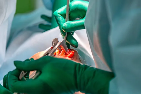 Cirurgião e seu assistente realizando cirurgia estética no nariz na sala de cirurgia do hospital. Reformulação do nariz, aumento. Rinoplastia . — Fotografia de Stock