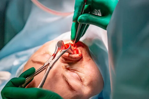 Cirujano y su asistente realizando cirugía estética en la nariz en el quirófano del hospital. Remodelación de la nariz, aumento. Rinoplastia . —  Fotos de Stock