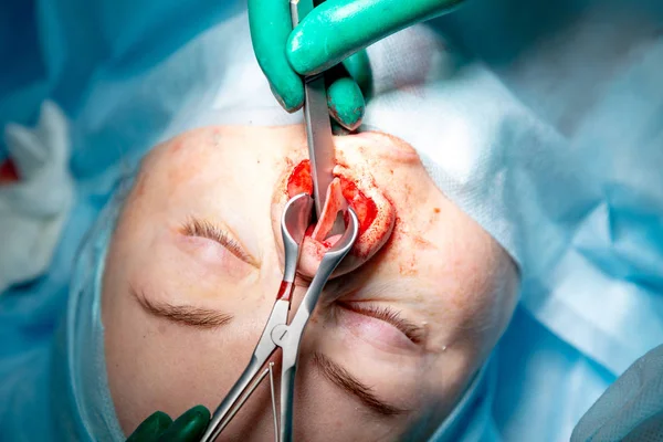 Cirurgião e seu assistente realizando cirurgia estética no nariz na sala de cirurgia do hospital. Reformulação do nariz, aumento. Rinoplastia . — Fotografia de Stock