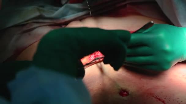 Abdominoplasty van de buik. Liposuctie van de buik. Gedeeltelijke verwijdering van vet en slijm-weefsel van de buik. De Arts snijdt een chirurgische scalpel van laser. — Stockvideo