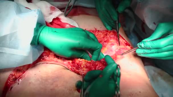Abdominoplasty of the abdomen. Abdominal liposuction. Partial removal of fat and mucous tissues of the abdomen. The doctor cuts a laser surgical scalpel. — Stock Video