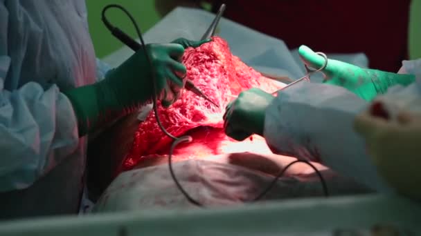 Abdominoplasty van de buik. Liposuctie van de buik. Gedeeltelijke verwijdering van vet en slijm-weefsel van de buik. De Arts snijdt een chirurgische scalpel van laser. — Stockvideo