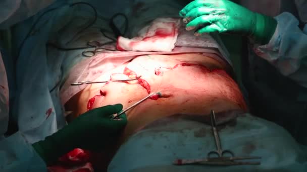 Cirujano plástico realiza una operación de abdominoplastia con una transferencia del ombligo — Vídeo de stock