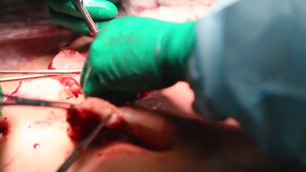 Пластический хирург проводит операцию по абдоминопластике с переносом пупка — стоковое видео