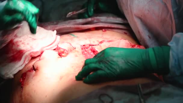 整形外科医は、へその転送で腹部の操作を実行します。 — ストック動画