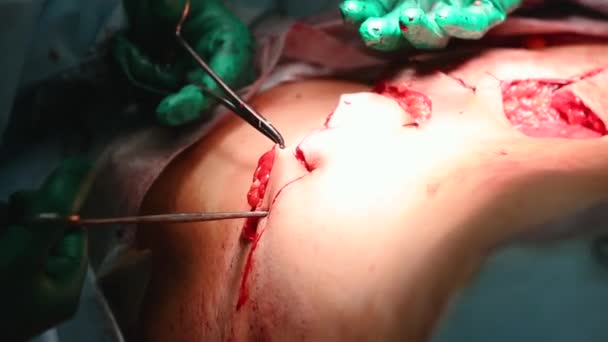 Пластический хирург проводит операцию по абдоминопластике с переносом пупка — стоковое видео