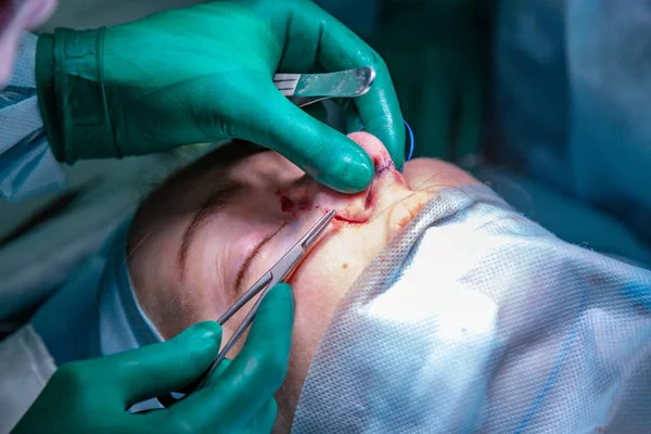 Cirujano y su asistente realizando cirugía estética en la nariz en el quirófano del hospital. Remodelación de la nariz, aumento. Rinoplastia . — Foto de Stock