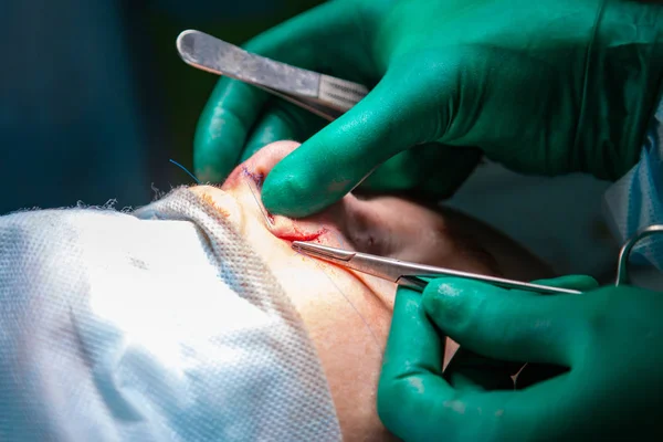 Cirurgião e seu assistente realizando cirurgia estética no nariz na sala de cirurgia do hospital. Reformulação do nariz, aumento. Rinoplastia . — Fotografia de Stock