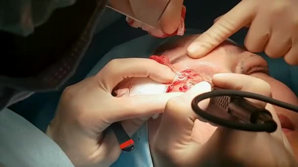 Ο χειρουργός εκτελεί μια λειτουργία σε τα μάτια, Φράζω. Διόρθωση. Ο γιατρός κάνει βλεφαροπλαστική. Λειτουργία στο χειρουργείο. — Αρχείο Βίντεο